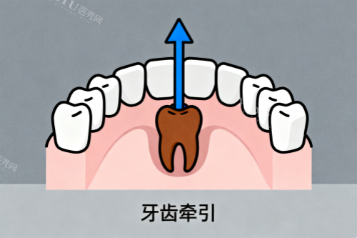 牙齿牵引卡通图
