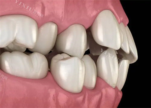 牙齿拥挤不整齐图