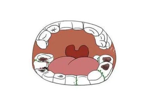 牙齿蛀牙问题卡通图