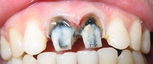 烤瓷牙前牙齿的情况