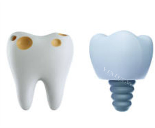 坏的牙齿和种植牙