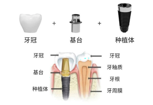 威高种植牙手术过程示意图