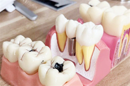 合肥靓美口腔医院种植牙模型