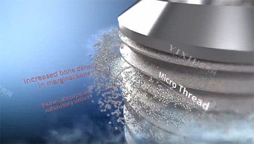 沃兰种植牙表面材料图