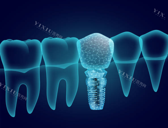 种植牙模型图卡通图