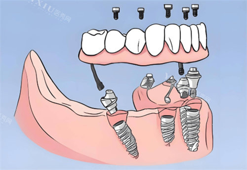 全口种植牙卡通图片