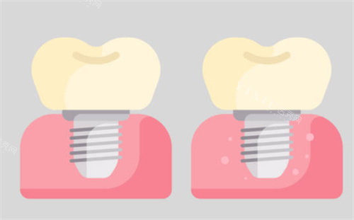种植牙对比图