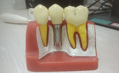 广州欧迈口腔种植牙模型图