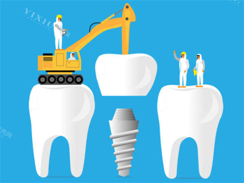 种植牙工程示意图