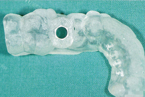 后牙种植牙导板