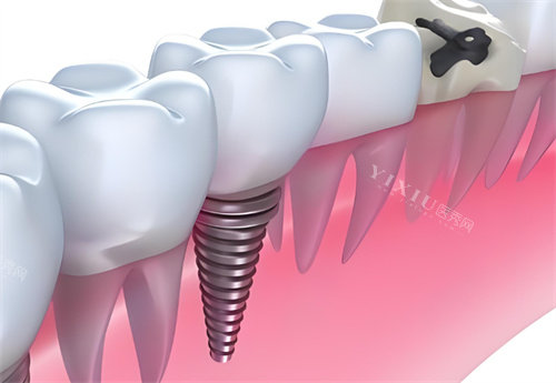 种植牙卡通展示