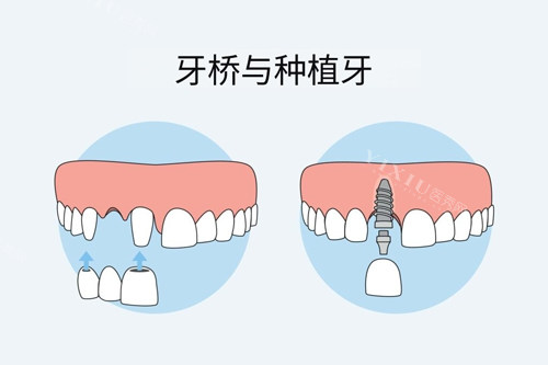 牙冠桥和种植牙对比图