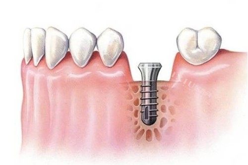 种植体植入步骤图