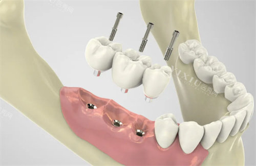 种植牙过程展示图片