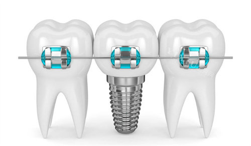 种植牙牙齿矫正图片