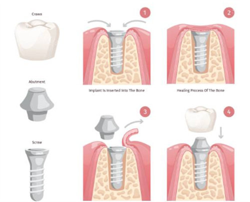 种植牙过程图