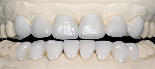 阿曼吉尔巴赫义齿多少钱一颗？系列、地区差异影响价格，真相在这里！(图3)