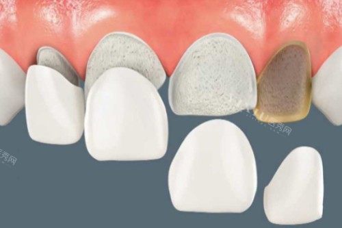 牙贴面卡通图片展示