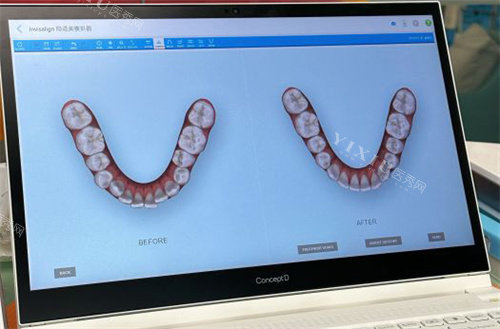北京亿阳口腔牙齿模拟图