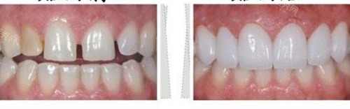 牙齿贴面前后示意图