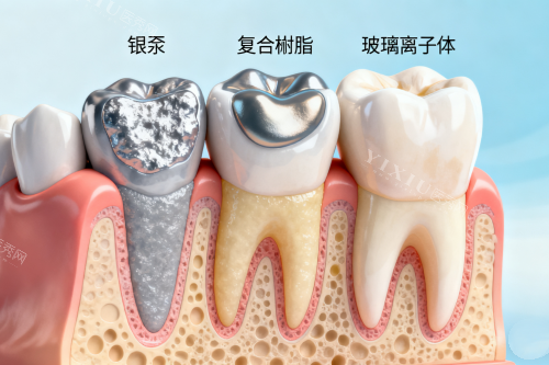合肥美奥口腔补牙体验：材料多技术好，用一顿火锅钱搞定牙齿健康！(图5)