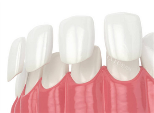 钟浩然医生牙齿贴面定制服务介绍，不同材质贴面价格对比，打造自然美观笑容！(图1)