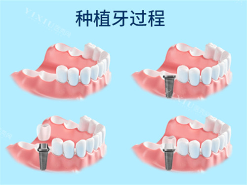 钛特利种植体国产身份实锤！特有盘点：本土研发团队+专有表面处理技术，为何能比肩进口品牌？(图9)