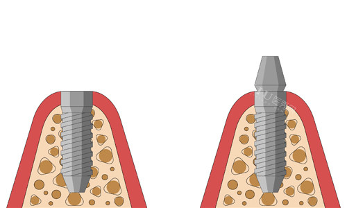 钛特利种植体国产身份实锤！特有盘点：本土研发团队+专有表面处理技术，为何能比肩进口品牌？(图5)
