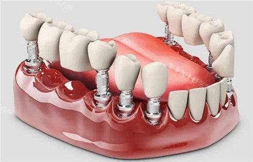 钛特利种植体国产身份实锤！特有盘点：本土研发团队+专有表面处理技术，为何能比肩进口品牌？(图3)