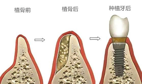 钛特利种植体国产身份实锤！特有盘点：本土研发团队+专有表面处理技术，为何能比肩进口品牌？(图1)