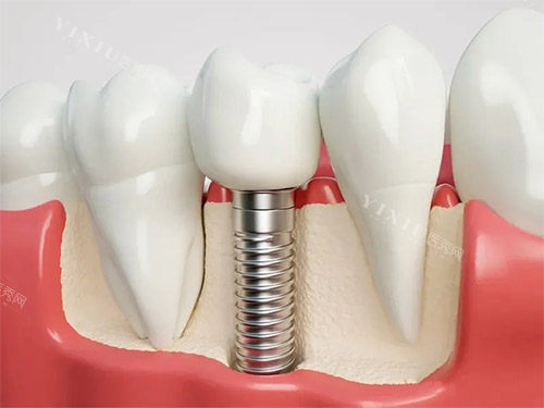 钛特利种植体国产身份实锤！特有盘点：本土研发团队+专有表面处理技术，为何能比肩进口品牌？(图4)