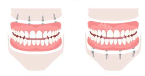 钛特利种植体国产身份实锤！特有盘点：本土研发团队+专有表面处理技术，为何能比肩进口品牌？(图8)