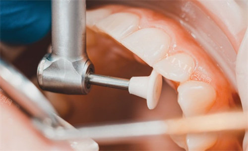 河北保定定兴致康口腔看牙价格一览：瓷贴面2690元起，种植牙3180元起！(图6)