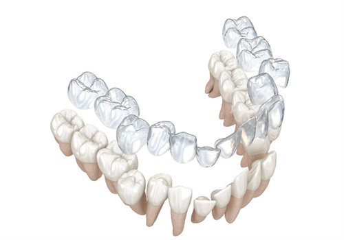 隐形矫正牙齿过程