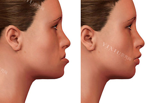 牙齿矫正对比图