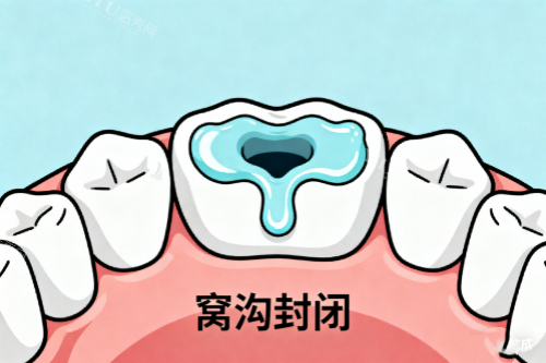 牙齿窝沟封闭展示图