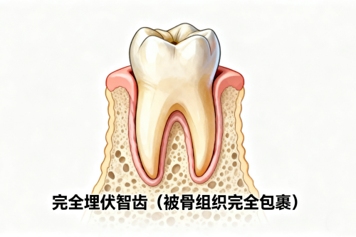 完全埋伏智齿一览