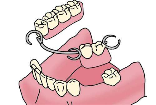 活动义齿动画图