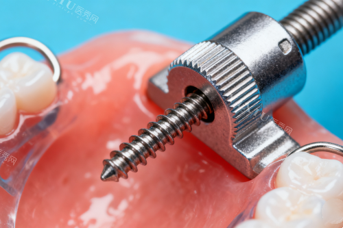 牙齿保持器安装图片一览