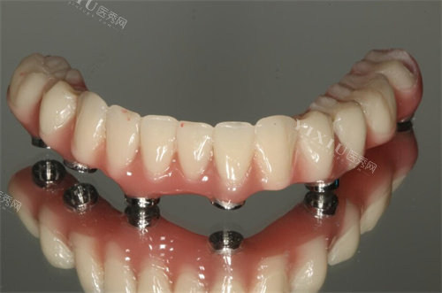 全口种植牙下颌