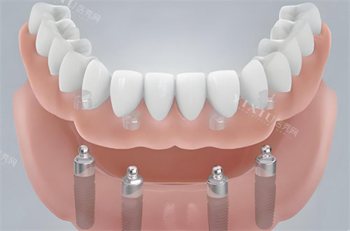 半口种植牙模型图展示