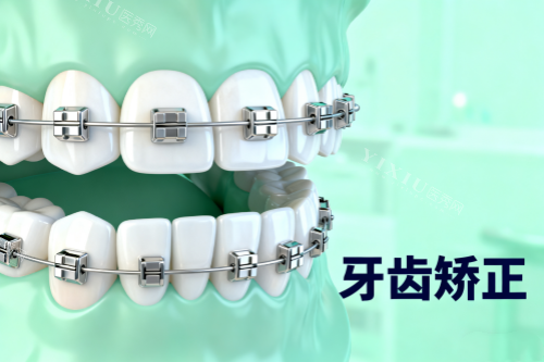 传统牙齿矫正方式展示