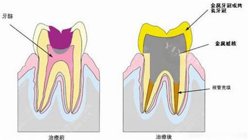 根管治疗后牙疼正常吗？根尖炎、填充超充、残髓都会痛，出现这几种症状别硬扛赶紧看-医秀网