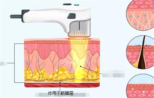 超声治疗作用于筋膜层动画展示