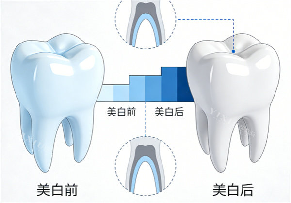 牙齿美白前后示意图
