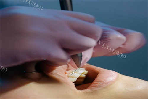 牙齿矫正操作中.jpg