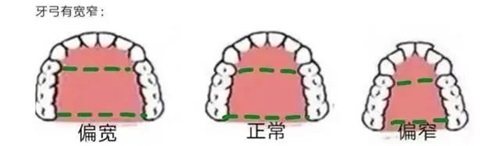 牙齿矫正牙弓形状.jpg