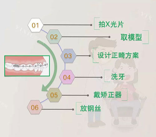 牙齿矫正流程.jpg